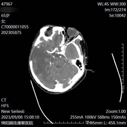 绵阳顾连康复医院对龚某头颈联合CT血管成像（CTA）检查