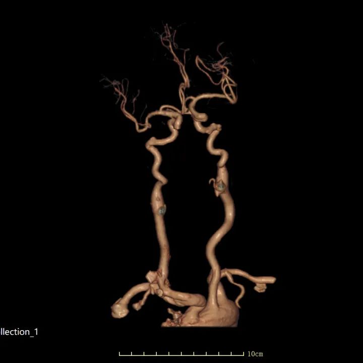 头颈联合动脉3D成像