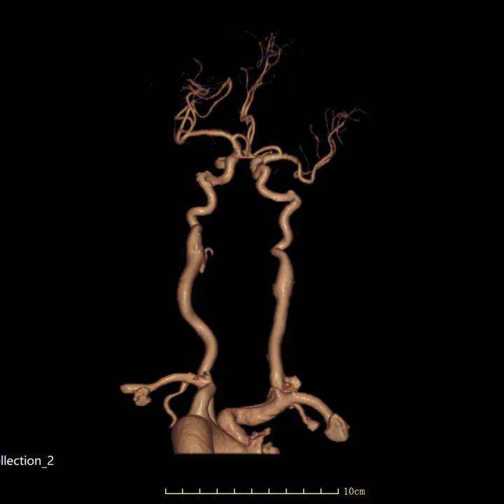 头颈联合动脉3D成像