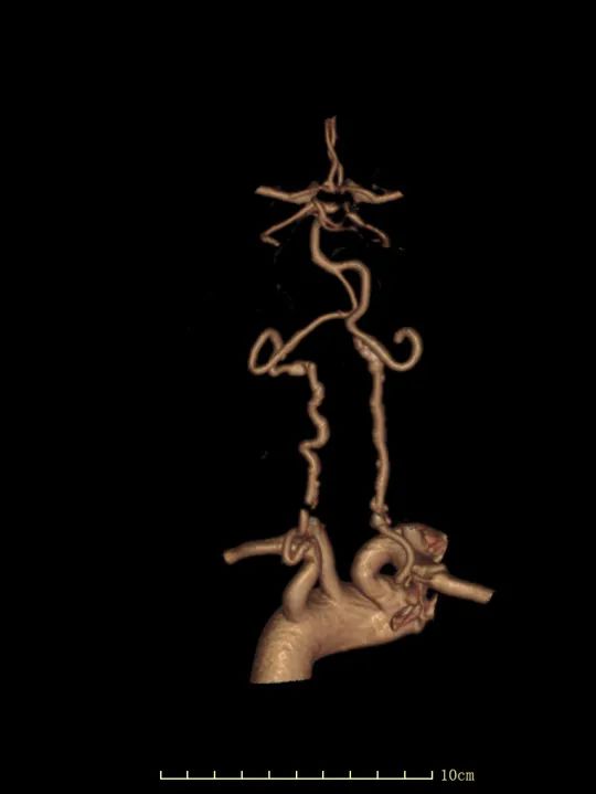 头颈联合动脉3D成像