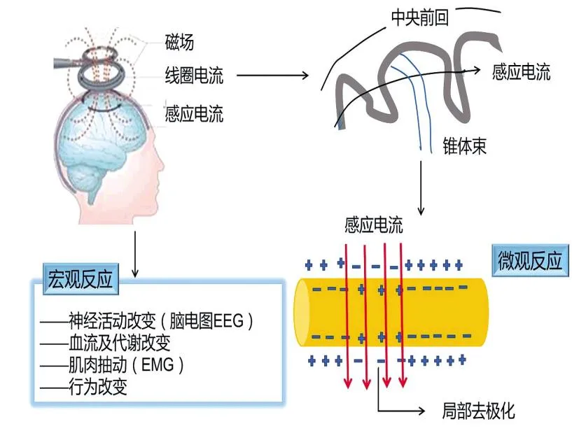 绵阳顾连康复医院康复科普|"敲敲头"就能治病？一分钟了解无痛康复"黑科技"——经颅重复磁刺激治疗