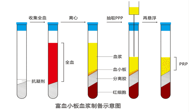 糖尿病足